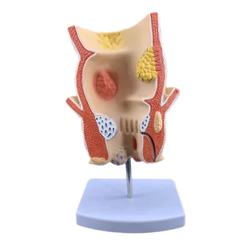 Анатомическая модель поражения патологии прямой кишки человека Геморрой Анус Медицинские учебные материалы